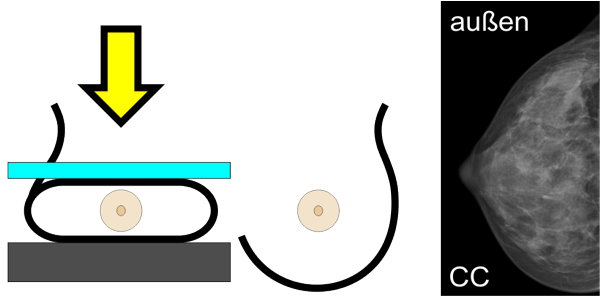 Mammographie cranio-caudal Schema